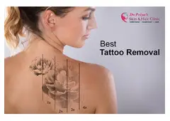Best Laser Tattoo Removal in Bangalore - Guaranteed Results