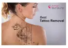 Best Laser Tattoo Removal in Bangalore - Guaranteed Results